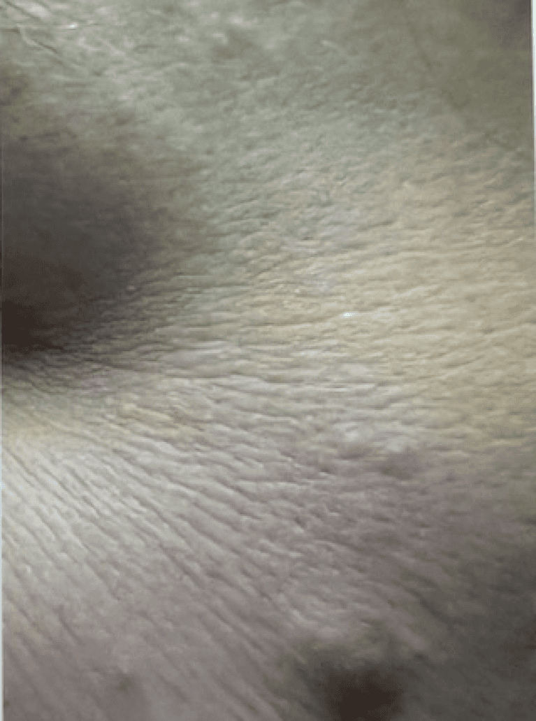 Botox-Treatment-After-Image