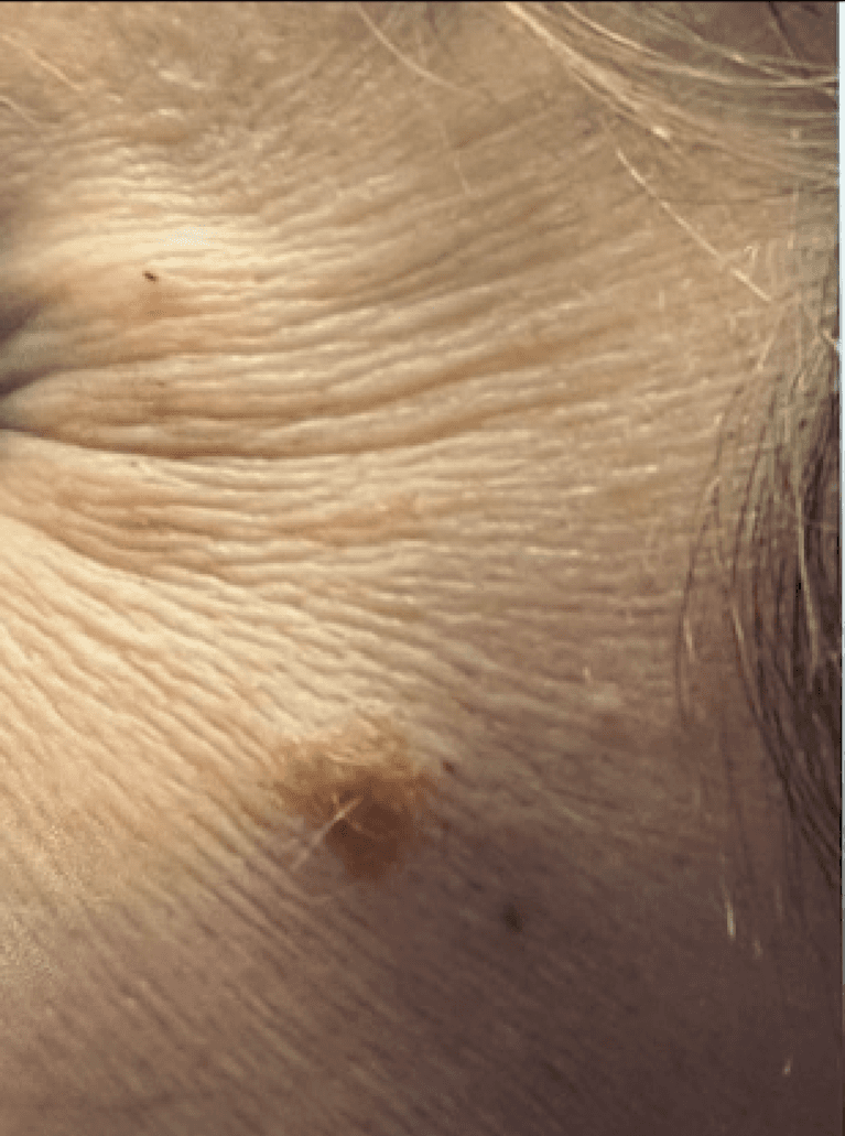 Botox-Treatment-Before-Image